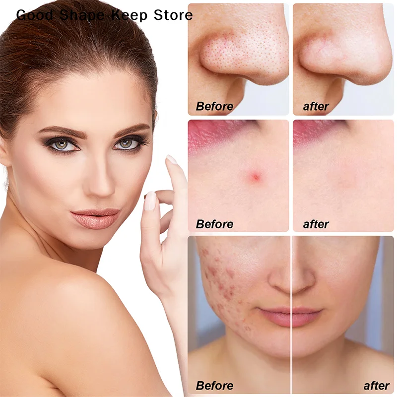 5Pcs Large Removal Full Face Pimple Patches Protect Skin Face Cleaning For Hydrocolloid Patch Acne Nose Chin Forehead For Cheek