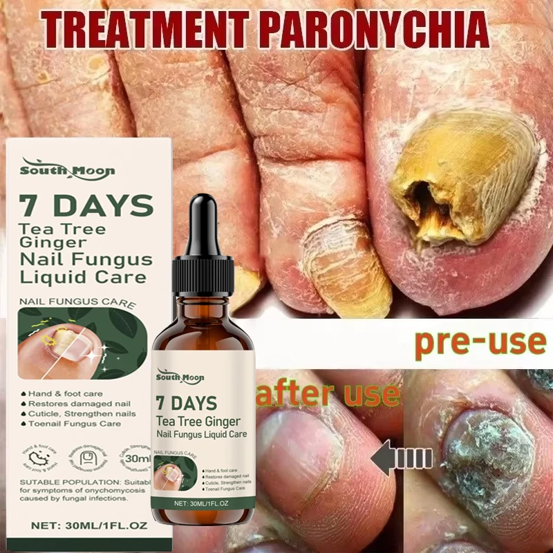 7Days Nail Fungus Treatment Serum Ginger Anti-infective Paronychia Onychomycosis Toe Foot Nail Fungal Repair Gel Hand Foot Care
