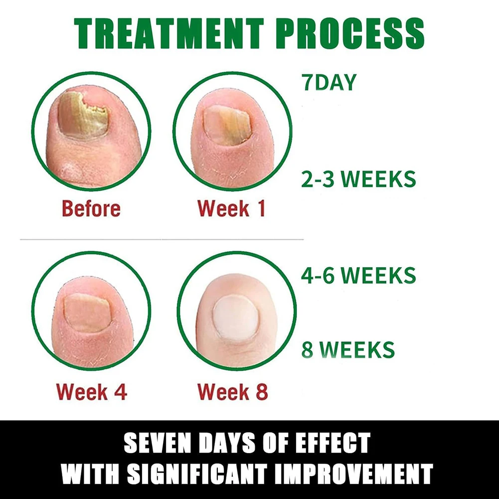 ครีมทามือไม่เหนียวเหนอะหนะบำรุงมือและเท้าเซรั่มดูแลเล็บสำหรับฤดูหนาวเนื้อเจลแห้งดูดซึมง่ายการรักษาเชื้อราที่เล็บ 20 มล