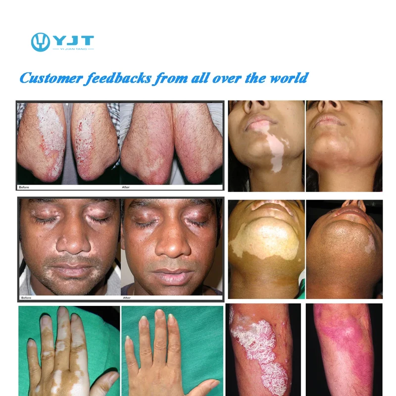 피부과 전문의는 아토피성 피부염 백반증 및 질병 치료를 위한 건선 치료 기계를 권장합니다.