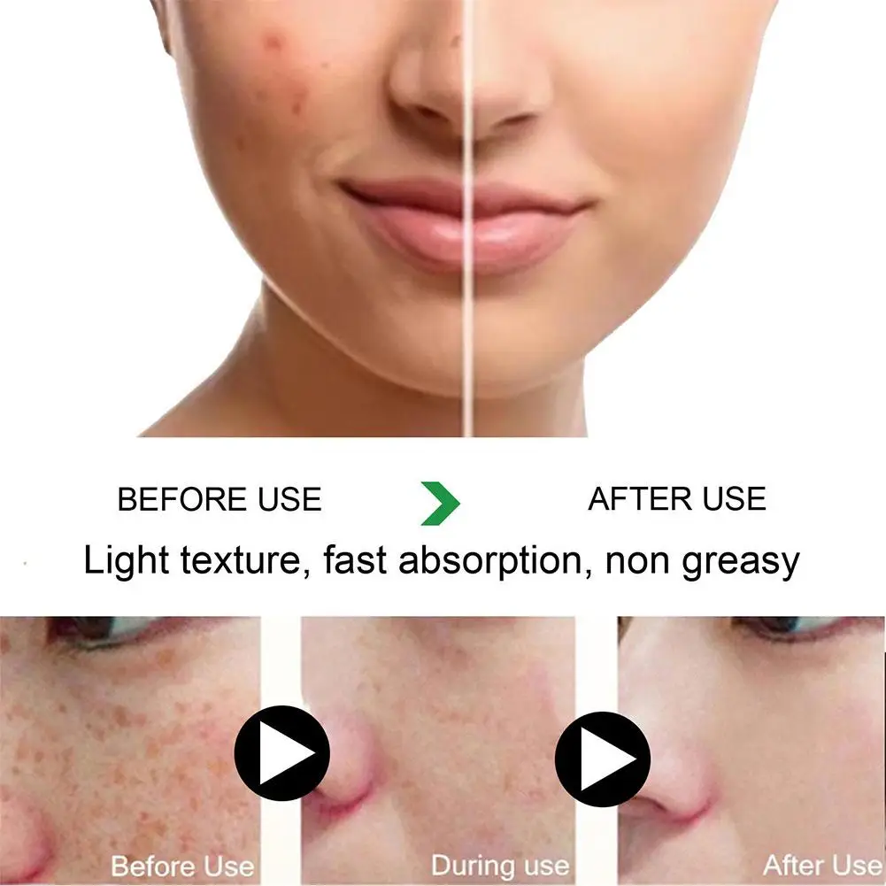 Effective Whitening Freckle Cream Remove Dark Spots Anti Freckle Cream Niacinamide Fade Pigmentation Melasma Brighten Creams