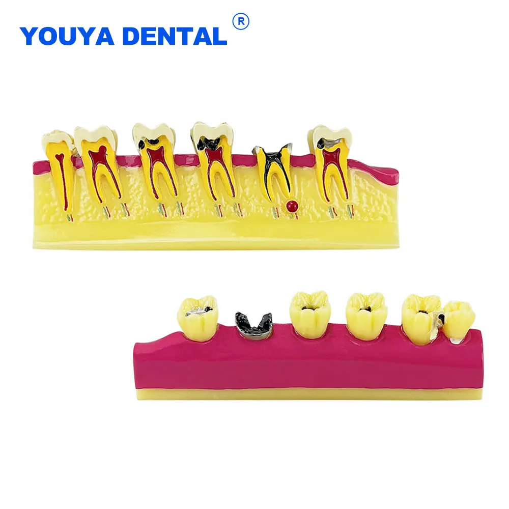 

Dental Odontologia Periodontal Disease Caries Model breakdown display for Teaching Study Education Dentist Communication Tools