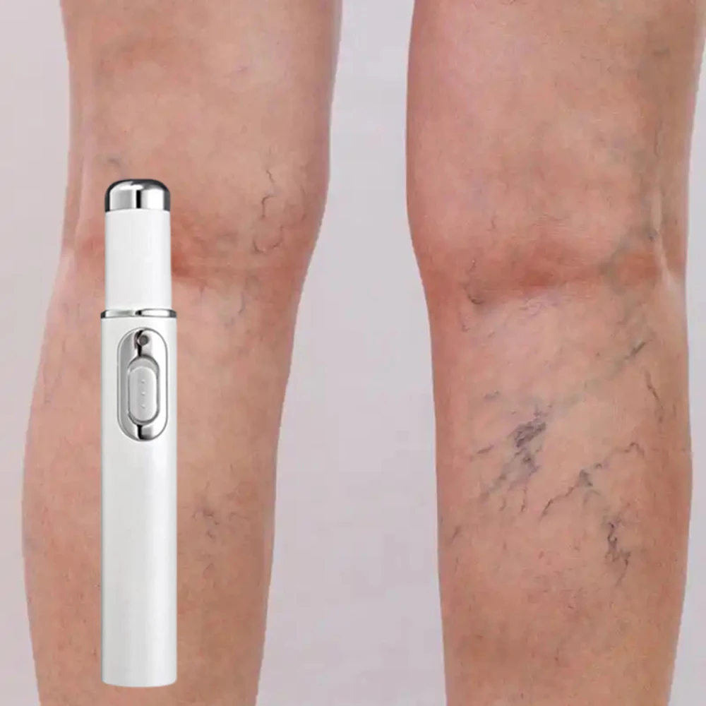 

Varicose Vein Laser Pen Lampshade Therapy Improved Blood Circulation Venous Repair In The Legs Phlebitis