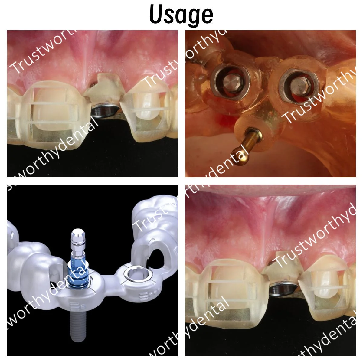 Dental ITI Sleeve Guided T-Sleeves ∅5.0 ∅2.2 Digital Guidance Guide Implant Aid Template Drills