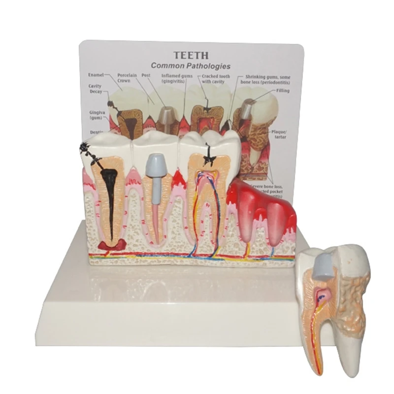 

7x5.9x5.1in Patient Education&Explanation Model for Study Teach Decay Teeth Model Tooth Pathology Display