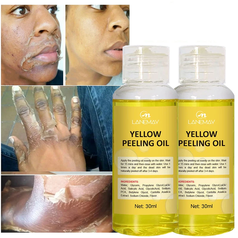 O óleo amarelo dos cuidados com a pele do descoramento, clarear o soro, esfoliating, pele inoperante, pele escura, remove, braço, joelho, pés,