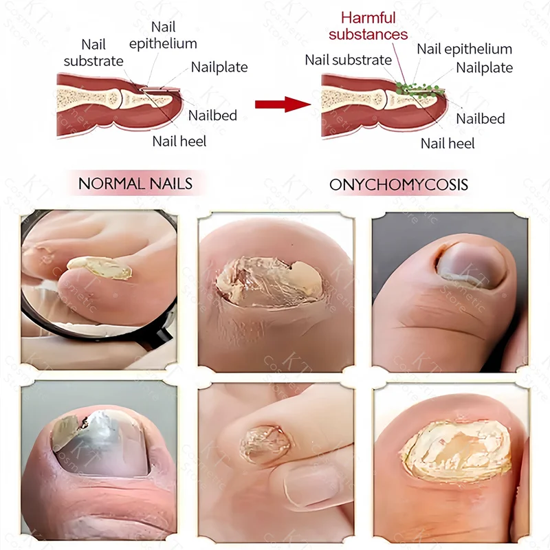 7 Days Nail Fungus Treatment Serum Ginger Anti-Infective Paronychia Onychomycosis Toe Foot Nail Fungal Repair Gel Hand Foot Care