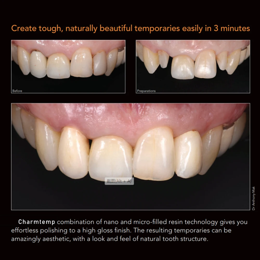 Corona y puente temporal Dental, Material de resina, autocurado, Luxa Pro, CharmTemp, dientes delanteros frontales, suministros de odontología