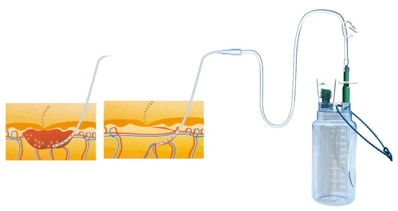 

High Pressure Bottle for Chest Wound Drainage Orthocare Vacuum Sealing System for Optimal Recovery