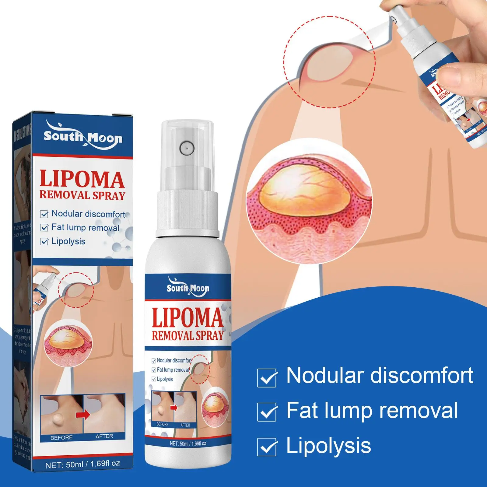 Lipoma Removal Spray Pain Treatment For Skin Swelling Fat Soluble Cellulite Fat Nodule Removal Cream Anti-tumor 50ml