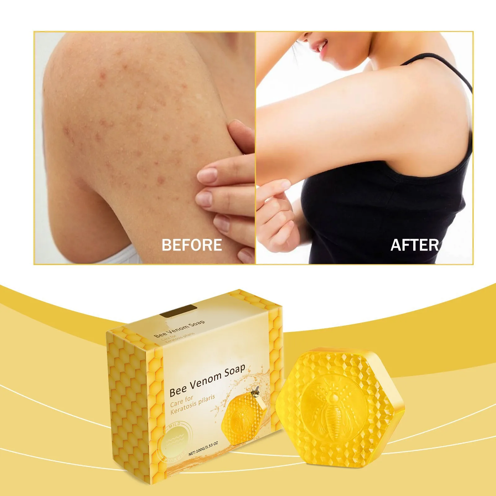 Bee Vēnom Soap Of Derma Care Soap Moisturizing & Cleaning Helping To Clear Accumulated Soap Men And Women Of All Ages