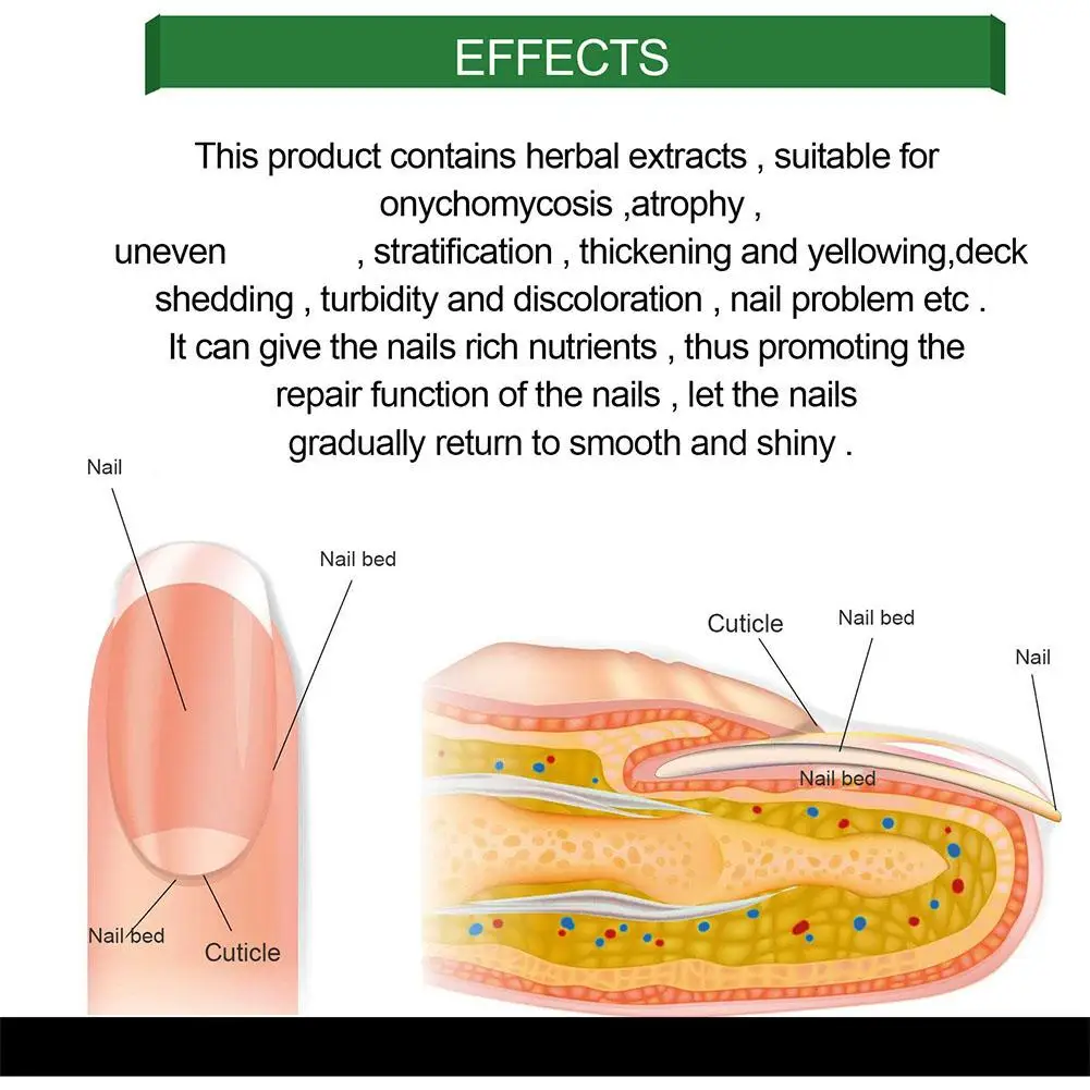 Nail Fungus Repair Liquid, Anti-infeccioso, Paroníquia, Onicomicose, Remoção Fungosa, Produtos de Saúde, 50ml