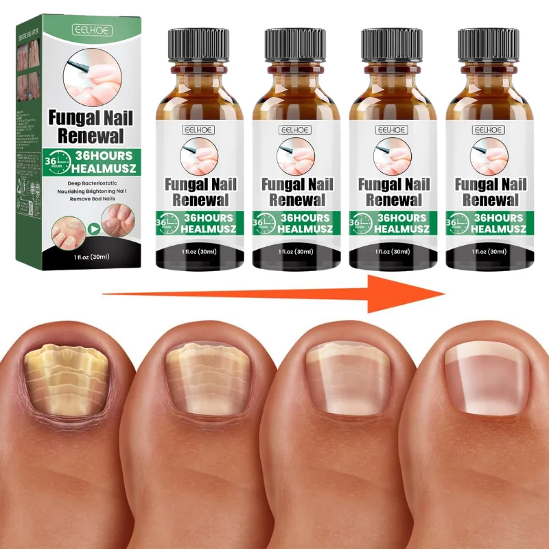 30ml Nail Repair/Strengthening Liquid Nourishing Brightening Care Serum For Damaged Thick Discolored Toenails Foot Nail Care Oil