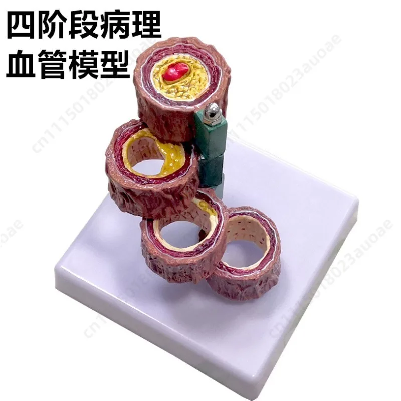 Human Blood Vessel Atherosclerosis Thrombus Model, Cardiovascular Artery Model, General Teaching Tool for Cardiology Education