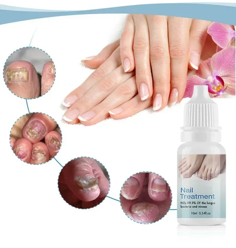 Nail Fungus Treatment Serum Foot Repair Liquid Toe Nail Fungus Removal Gel Anti Infection Paronychia Onychomycosis Oil