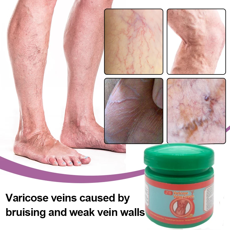 20g Varicose Veins Relief Ointment Effective Relieve Vasculitis Phlebitis Spider Pain Treat Cream Improves Circulation Body Care