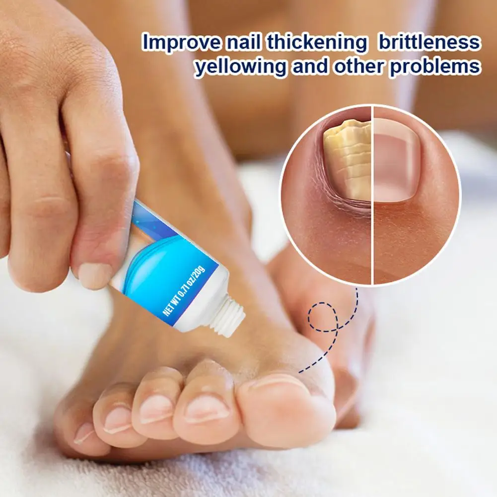 20g Effective Nail Treatments Cream Nail Fungus Removal Cream Toenail Onychomycosis Repair Soft Paronychia Nail Ointment