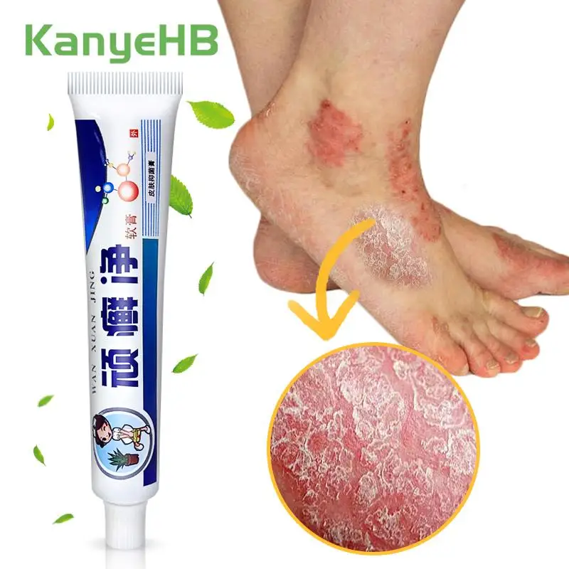 

1Pcs Chinese Herbal Medicine Psoriasis Cream Dermatitis Rash Private Parts Eczema Treatment Inhibit Fungus Anti-itch Cream S016