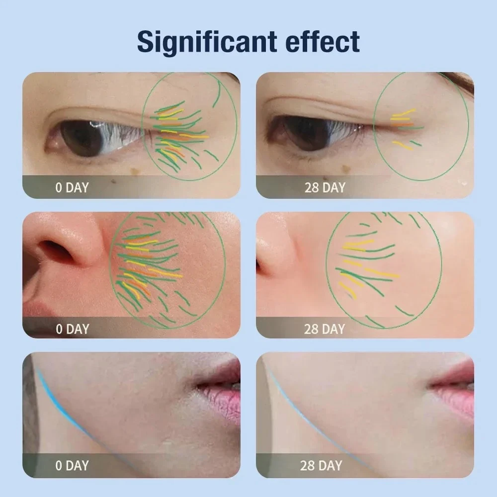 جهاز تجميل EMS متعدد الوظائف - مدلك علاج الثلج، أداة تنظيف المسام ومعدات شد الجلد للعناية اليومية #5