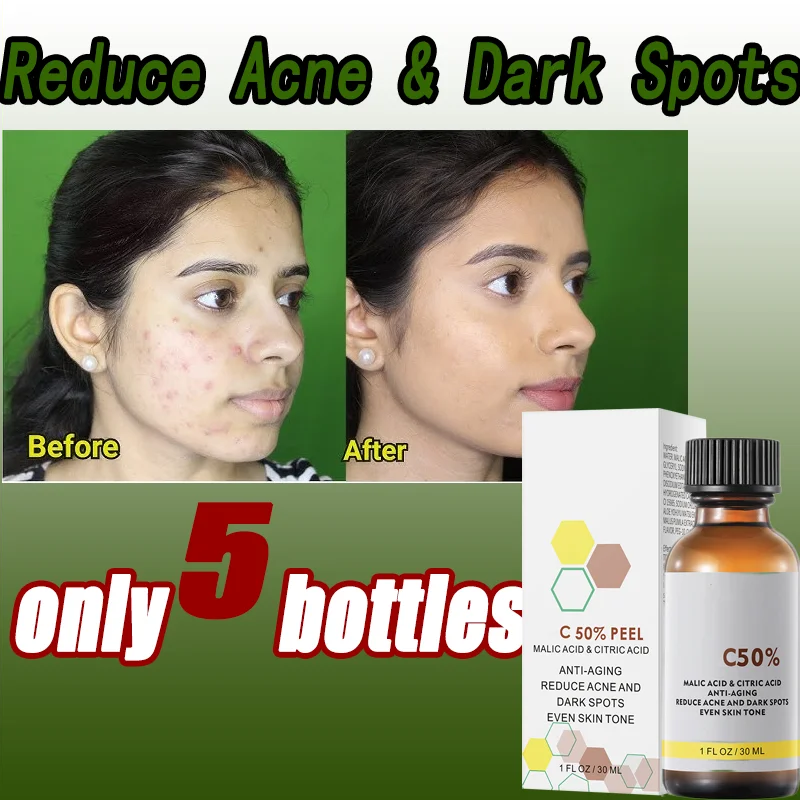 

With Malic Acid And Citric Acid For Face Facial Peel 40% Peeling Serum Peeling Serum Chemical Peel Reduce Acne and Dark Spots