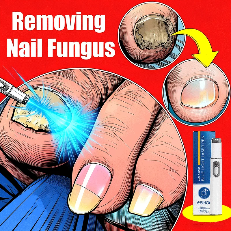 

Generation-2 Laser Says Goodbye To Nail fungus In 7 Days
