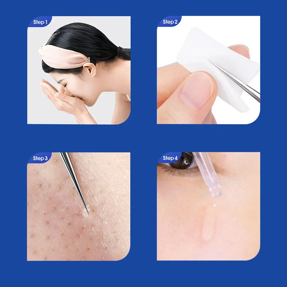Pinzette di precisione per punti neri in acciaio inossidabile - Strumento per la rimozione dell'acne per la cura della pelle del viso Kit di bellezza professionale per estrattore di comedoni