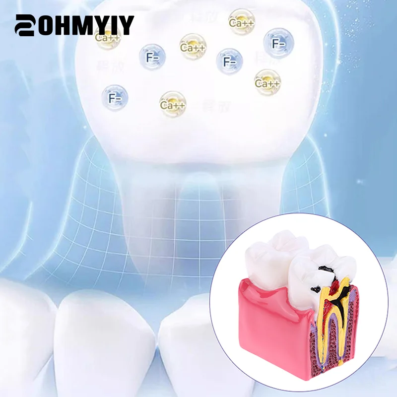 

1pc Dental Materials Lab Teeth Model 6 Times Caries Comparation Study Models For Dentist Studying and Researching