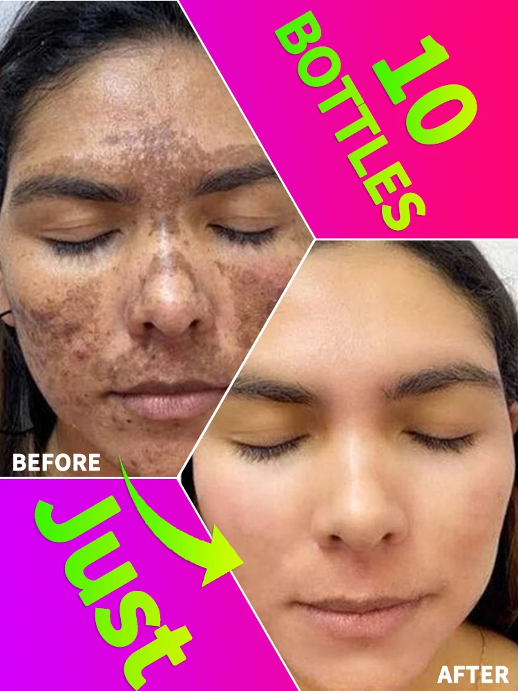 

Anti-freckle serum for removing pigmentation and dark spots