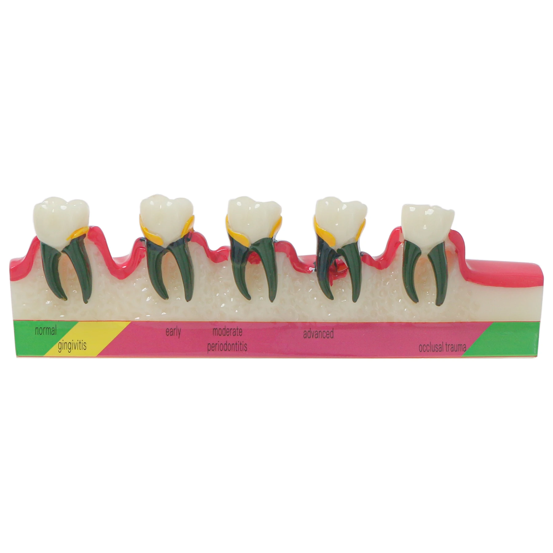 Dental Periodontal Disease Model  Typodont Teeth Disease Demo Teaching Model Caries M4029 1/5pcs