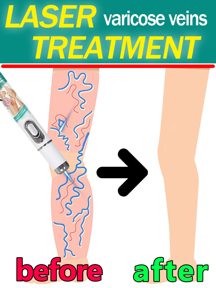 

Лазерное лечение варикозного расширения вен, лечит червячные вены, снимает боль в ногах от опухает кровеносные сосуды.