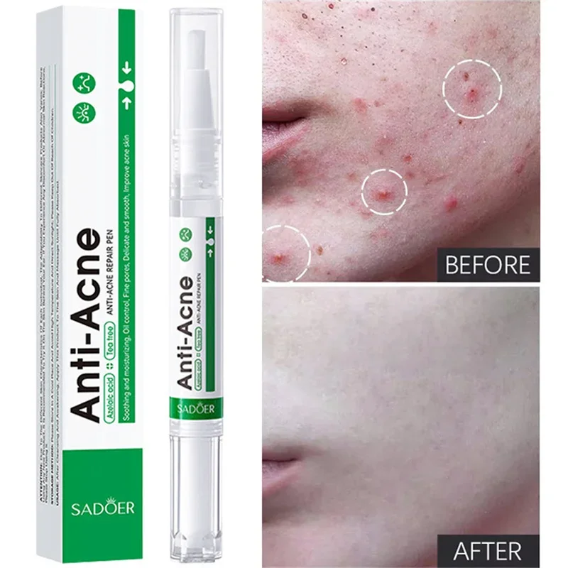 Salicylic Acid Acne Treatment Face Serum Repair Pimple Spots Deep Cleaning Pore Anti-acne Scar Oil Control Moisturizer Skin Care
