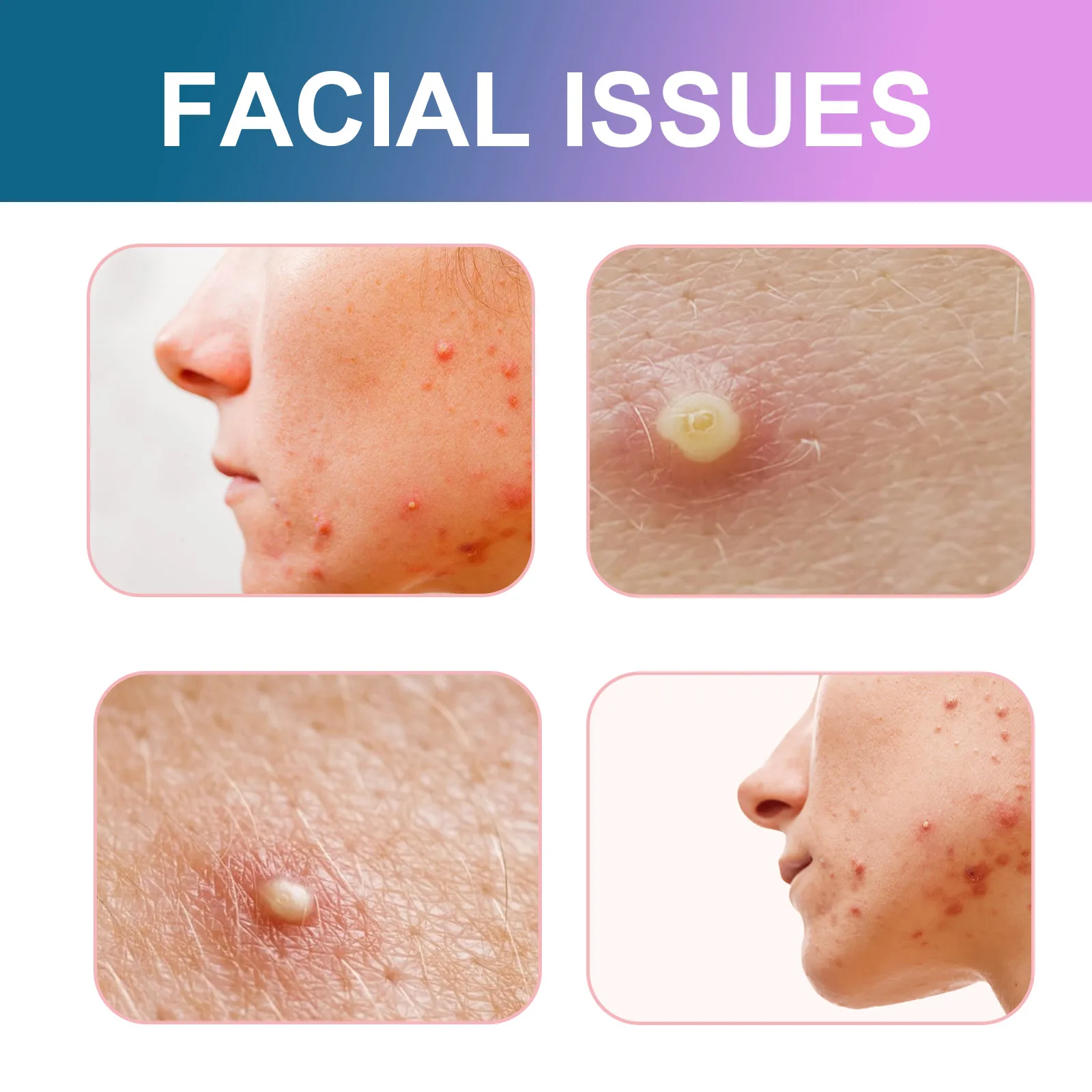OUHOE Cute Color Acne Patch Lighten Pimples Makeup Concealer Breathable Cute Color Acne Patch