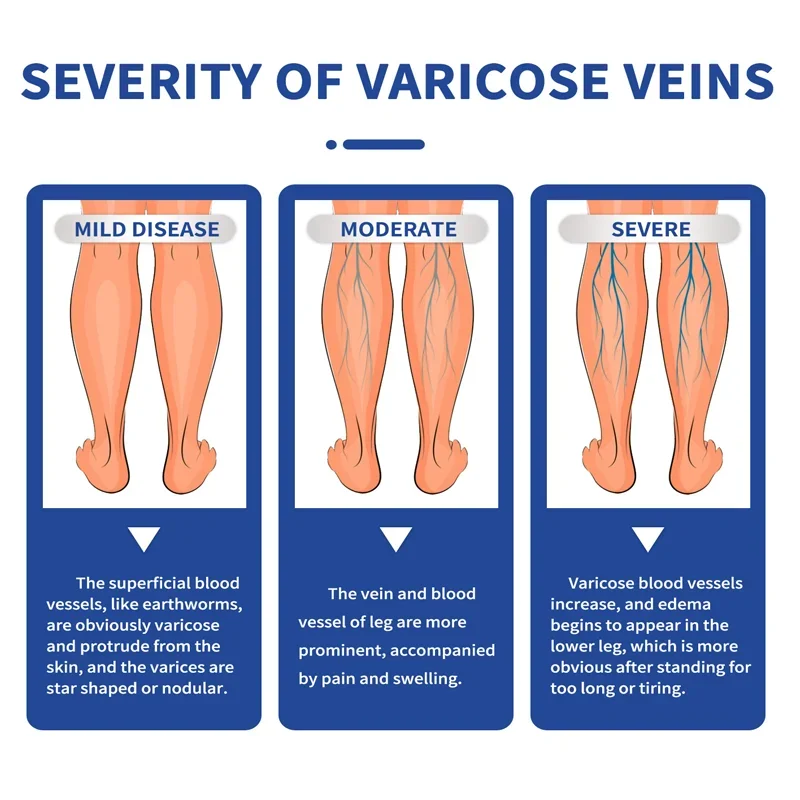 Laser Pen Lampshade Tool Varicose Veins Cream Remove Red Blood Streak Varicocele Vasculitis Phlebitis Strengthen Capillary