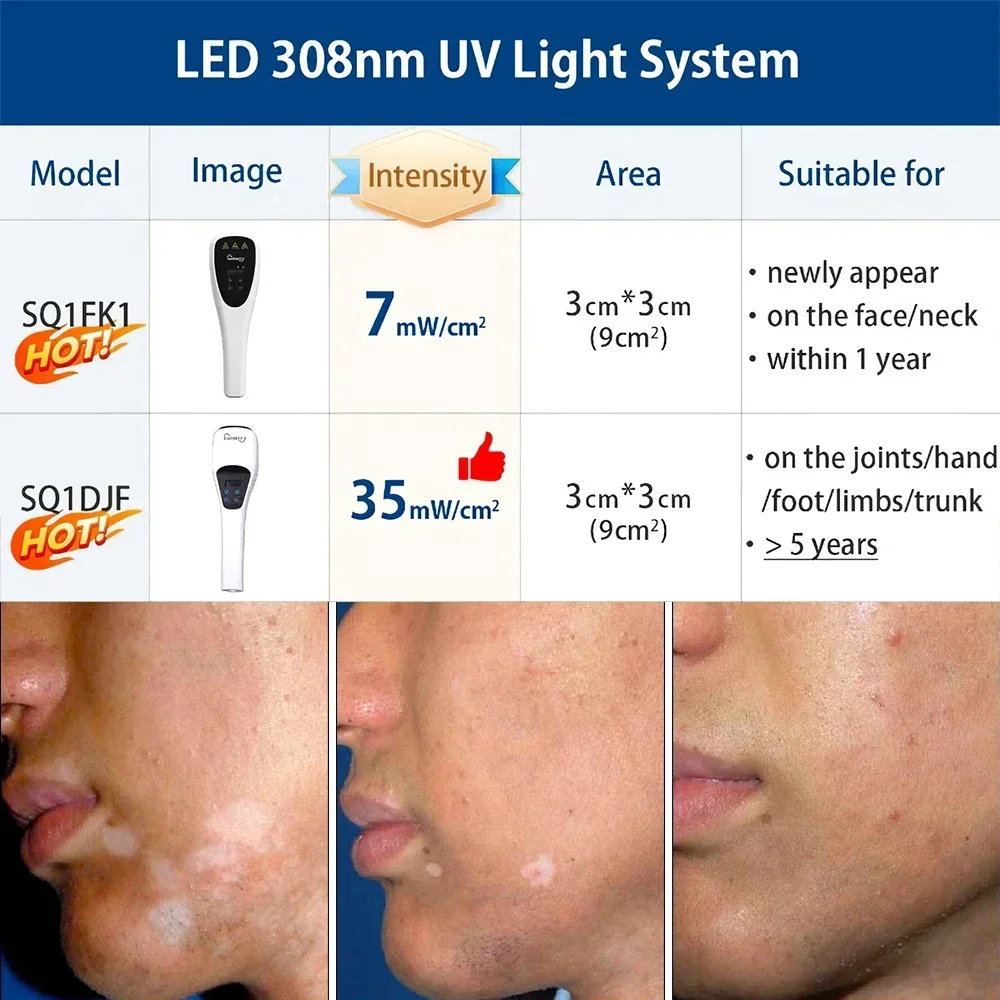 UVB luz portátil tratamento máquina, casa fototerapia, dermatite, micose, fungóides, pitiríase, rósea