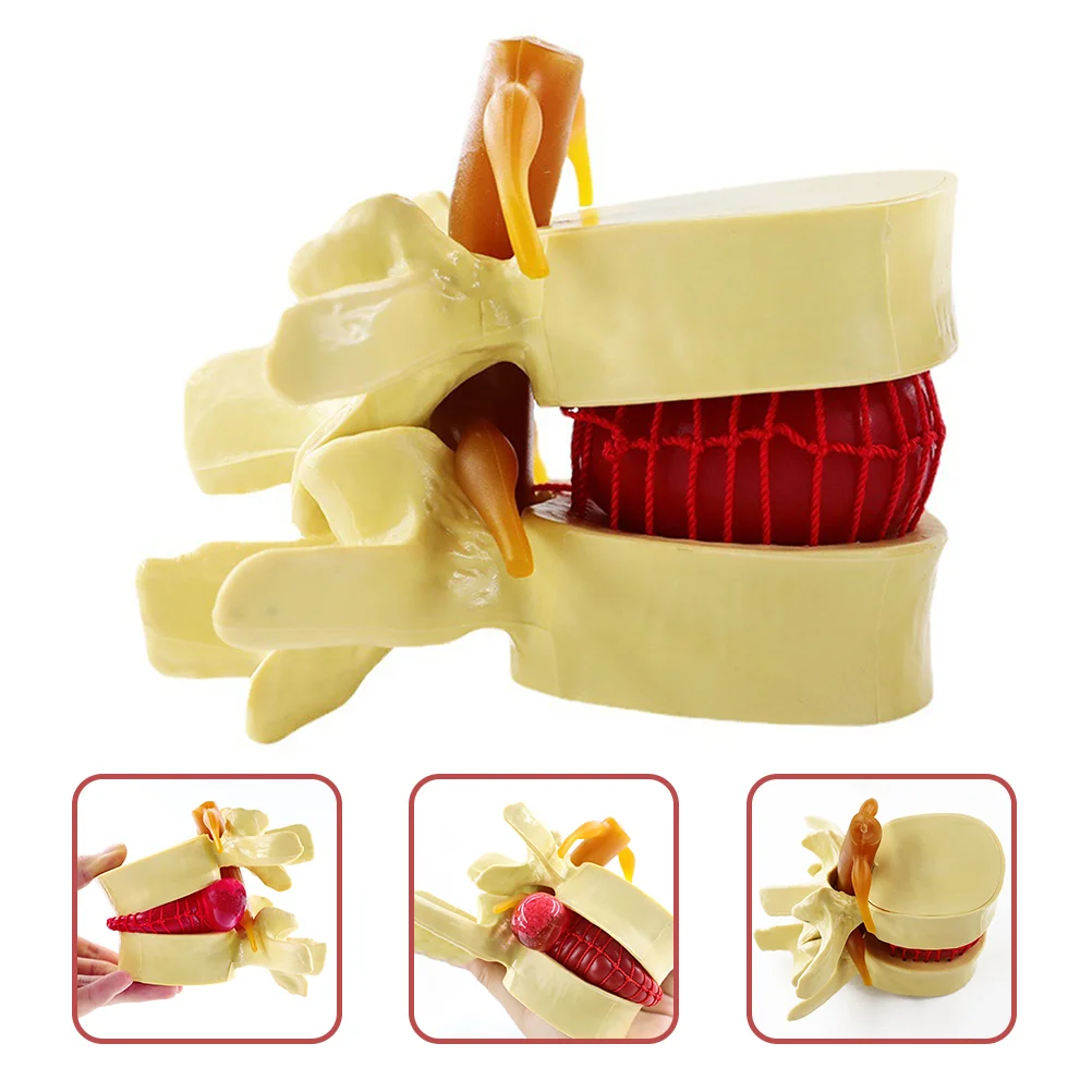 Intervertebral Disc Model Lumbar Herniation Demonstrating Models Anatomical Spine Human for Teaching