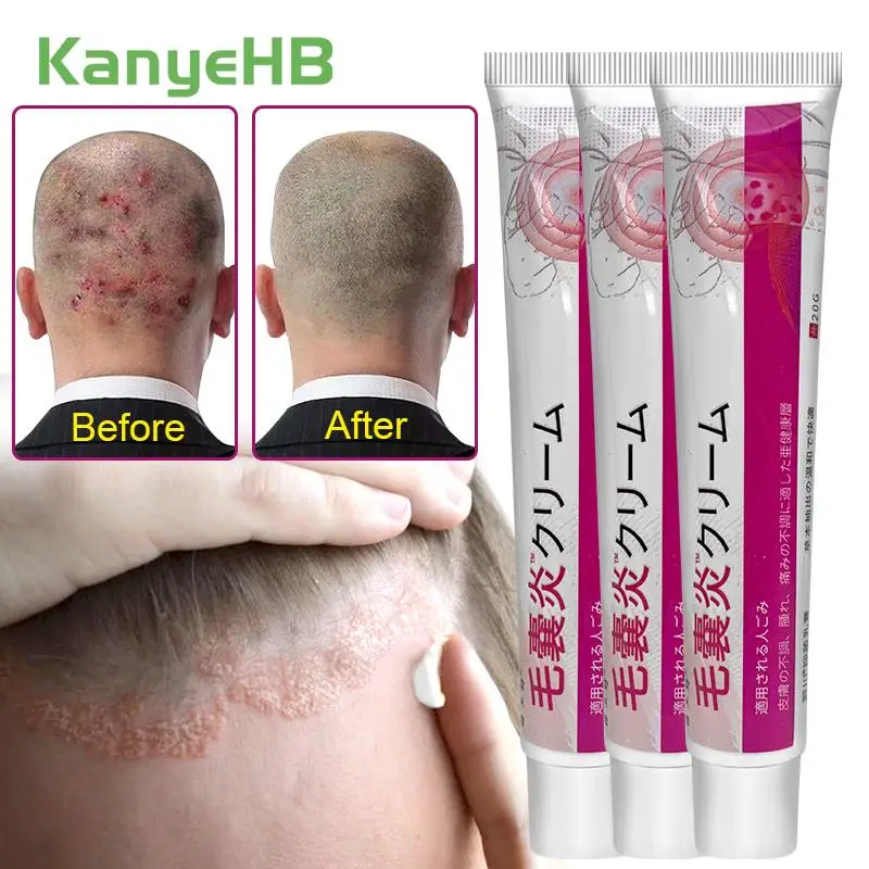 

3Pcs Acne Remove Cream Herbal Extract Psoriasis Eczema Rash Urticaria Treatment Repair Skin Antibacterial Itching Ointment A1712