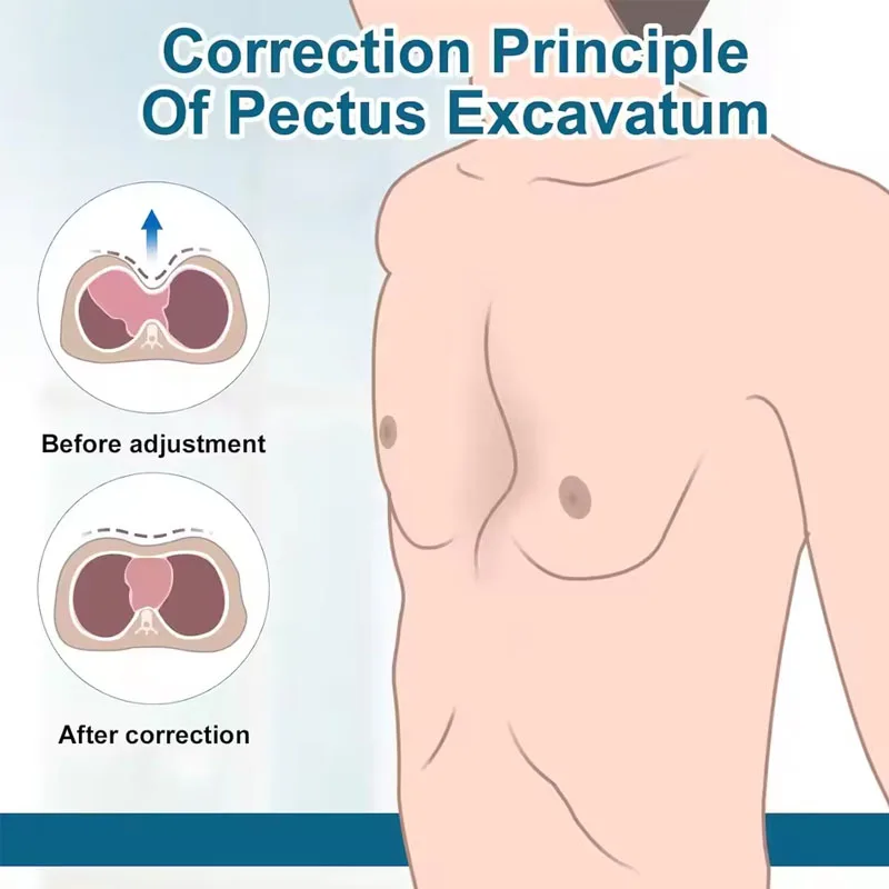 Pectus Excavatum Vacuum Bell,Pectus Excavatum Orthosis Brace,Sternal Depression Support Sunken Chest-Physical Chest Correction