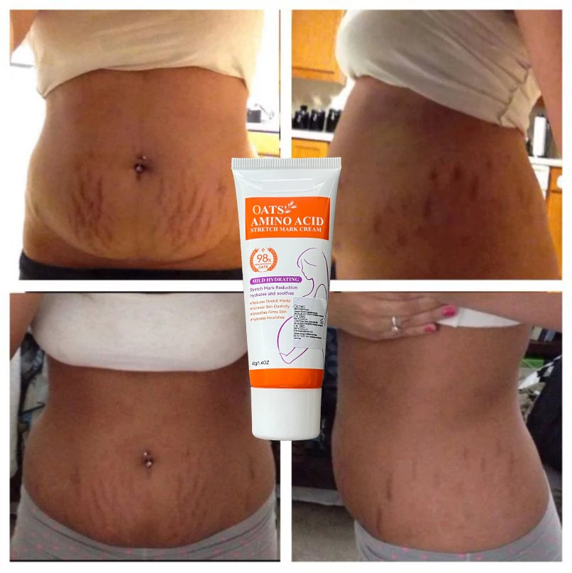 

Removing pregnancy wrinkles cream Removing postpartum obesity Repairing anti-aging firming body cream Skin care