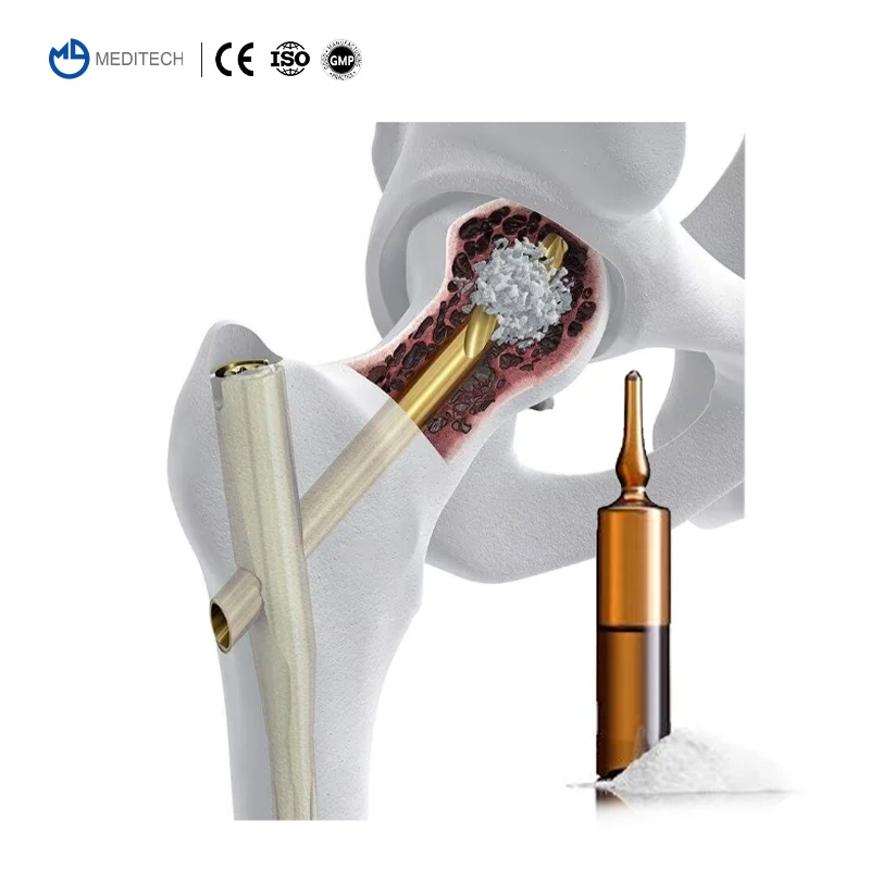 MEDITECH Best Quality and Price Surgical Bone Cement bone cement injector Joint Bone Cement