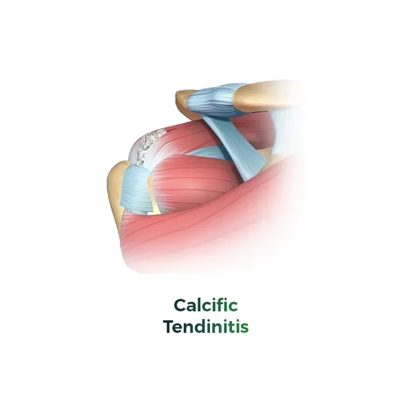 High-Performance Shock Wave Therapy Focal Shockwave Therapy Device for CalcificTendinitis