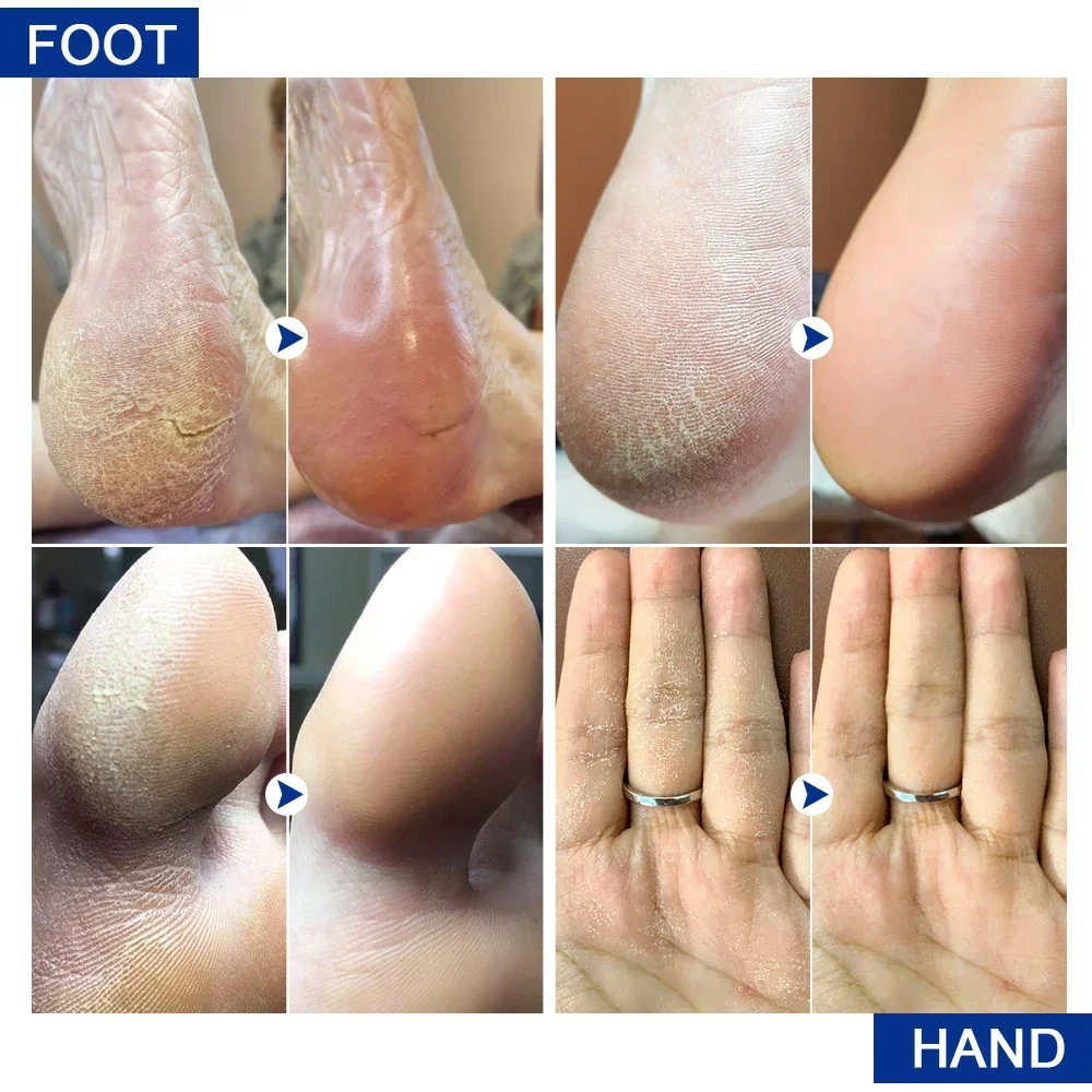 Anti Crack Hand Foot Cream Anti-Drying Heel Cracked Repairs Feet Mask Removal Dead Skin Moisturizing Whitening Smooth Feet Care