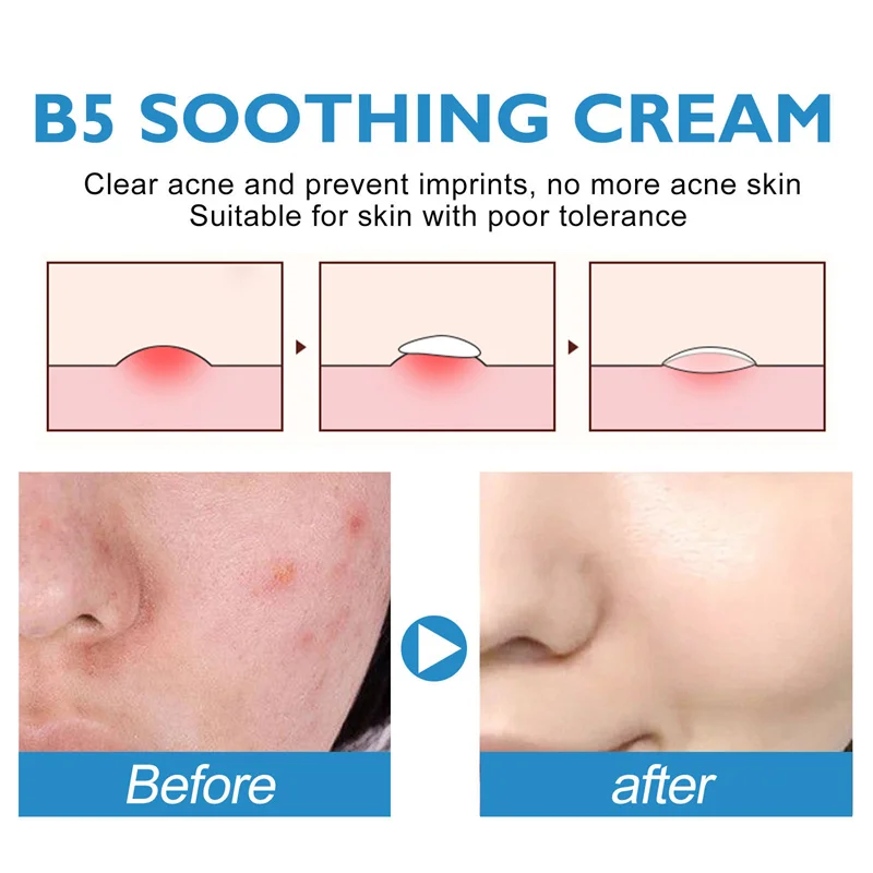 B5 Facial Redness Repair Cream Sunburn Repair Soothing Sensitive Skin Rosacea Itching Improve Moisturing Care Cosmetics