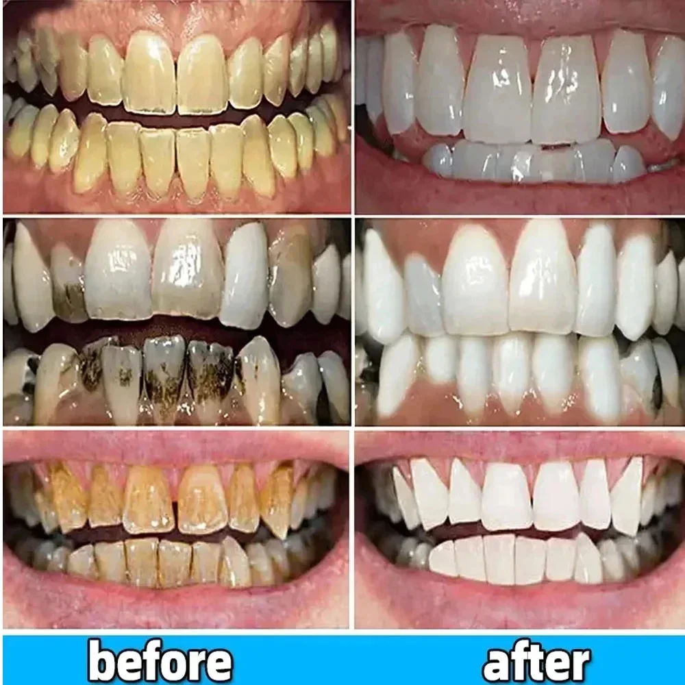 Whitening Teeth Toothpaste Dental Calculus Remover Serum Preventing Periodontitis Oral Odor Removal Cleansing Teeth Health Care