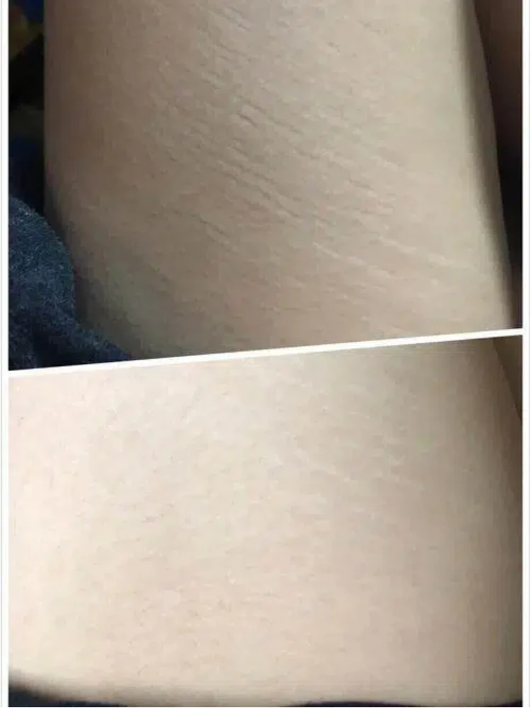 

Nuevos 4 Manijas Frío y calor para tensar la piel facial, reducir grasa, firmar y moldear