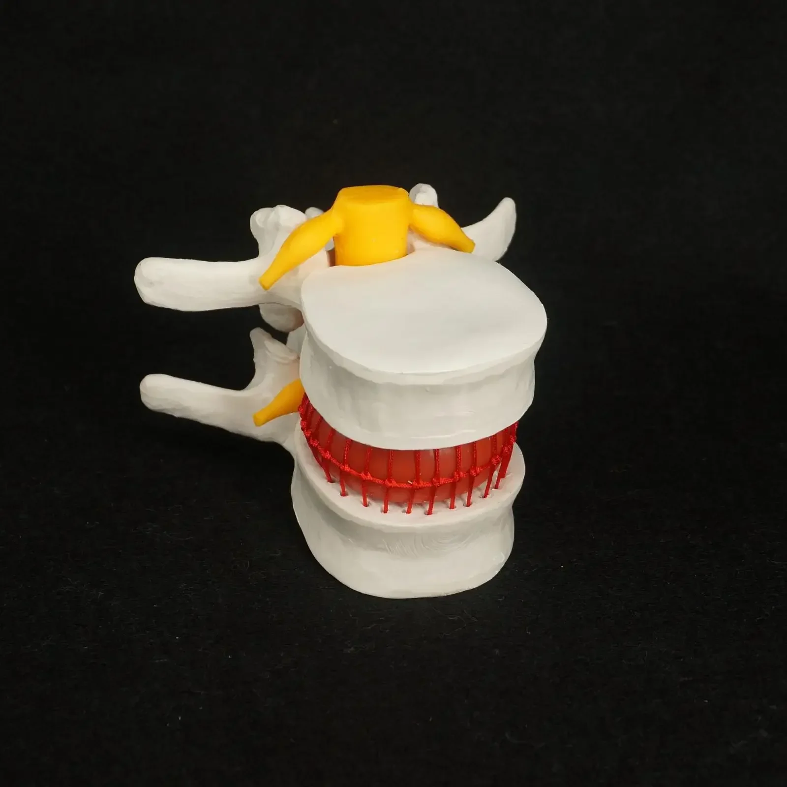 Modelo de prolapso de disco de vértebras lumbares hernia anatómica de PVC anatomía médica humana