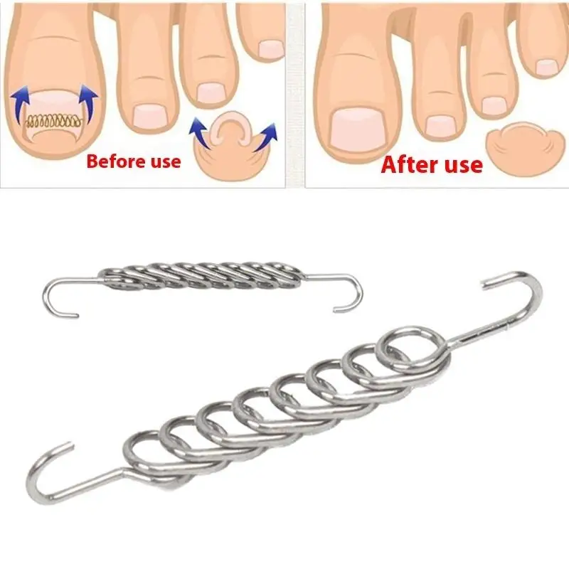 Ingegroeide Teennagel Corrector Gereedschap Pedicure Herstellen Embedden Teen Nagel Behandeling Professionele Ingegroeide Teennagel Correctie Voet CareTool