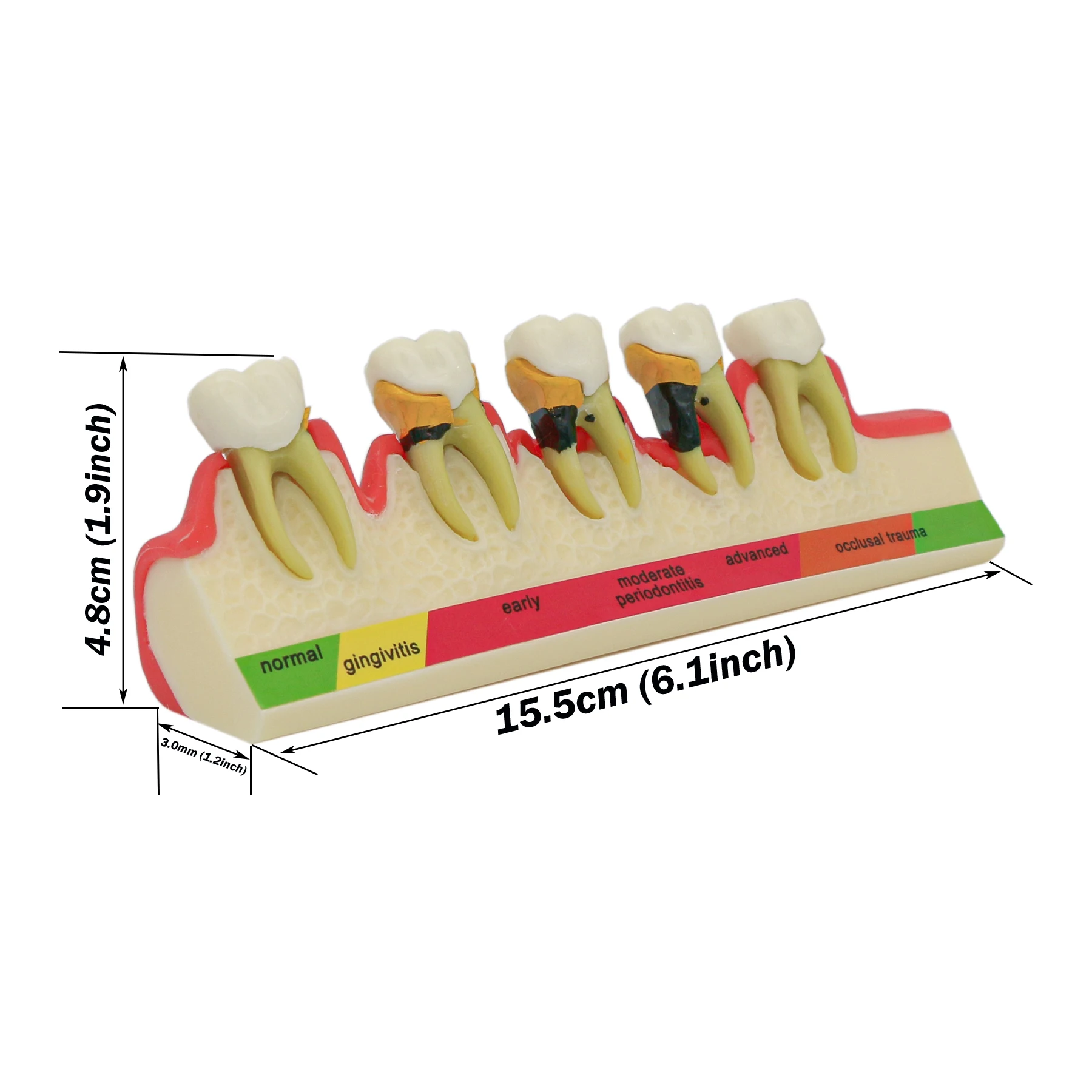 

Dental Periodontics Typodont Teeth Model 5-Stage Perio Disease Assort Demo Training dentists Teeth Model Periodontics M4010