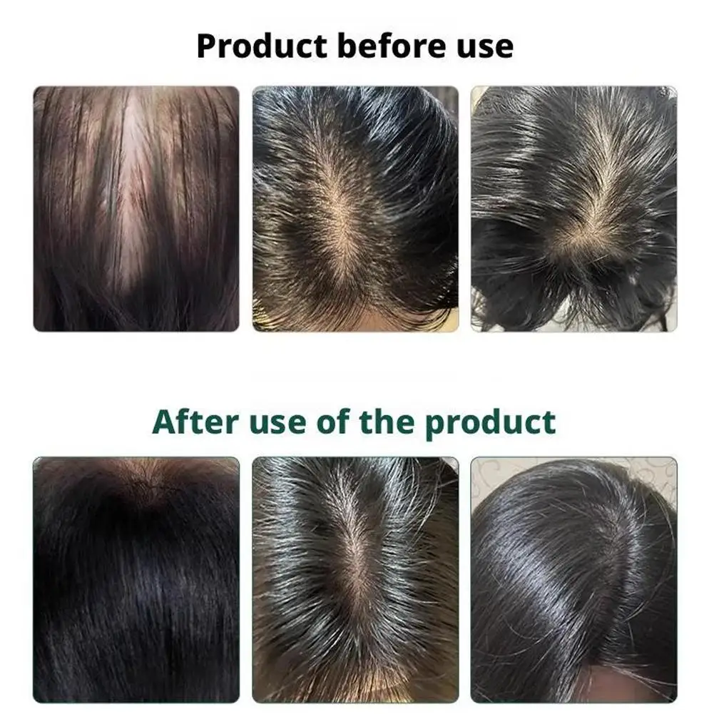 

120ML Zhangguang 101 Hair Follicle Nourishing Tonic Strong Hair Regrowth Product Hair Regain Tonic Beard Growth Hair Loss CARE