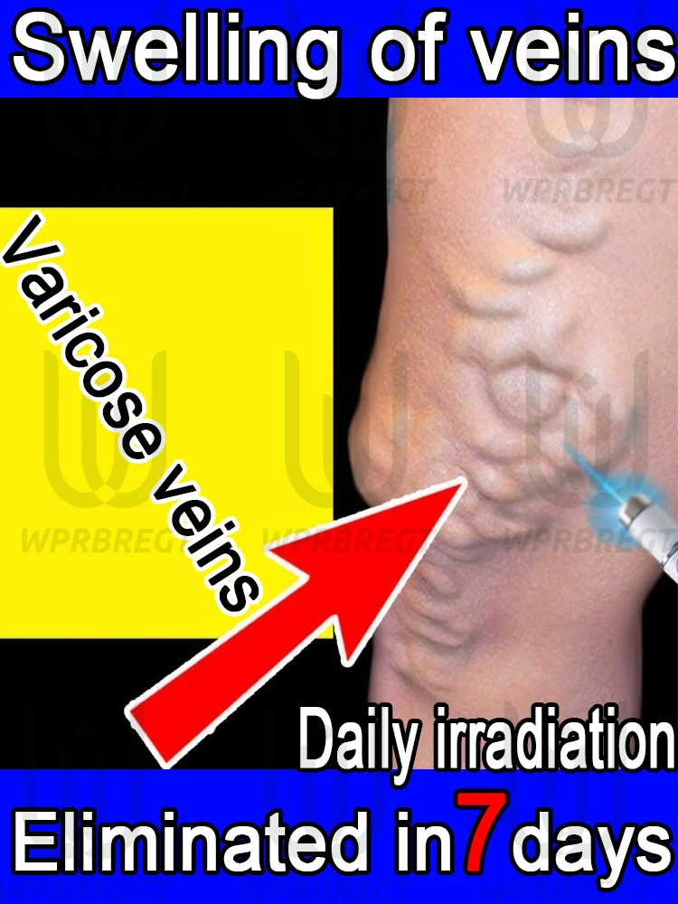 

Swollen veins, daily irradiation can eliminate varicose veins in 7 days