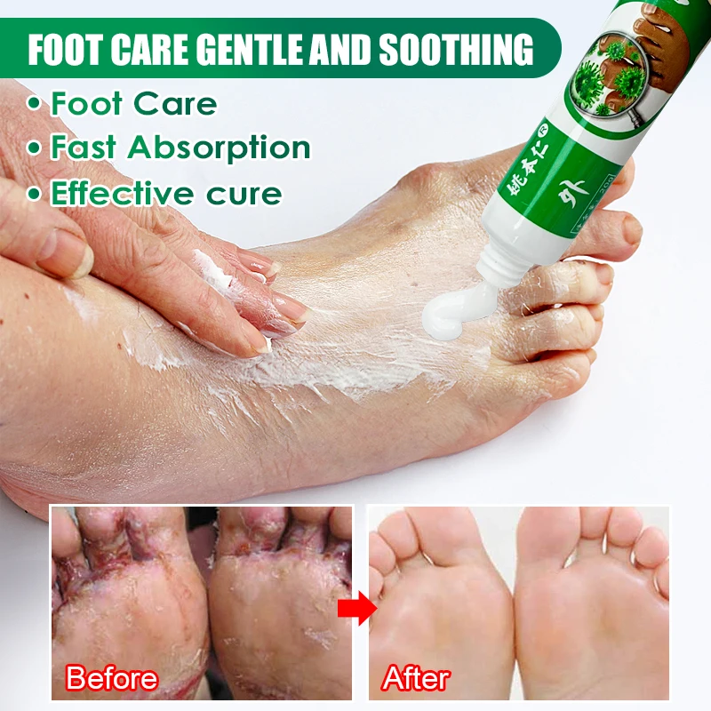 1Pcs Anti Fungal Beriberi Cream Treat Tinea Pedis Blisters Medical Cream Anti Infections Anti Itch Foot Odor Relief Cream S053